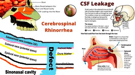 csf leak from nose test|CSF leak (Cerebrospinal fluid leak)